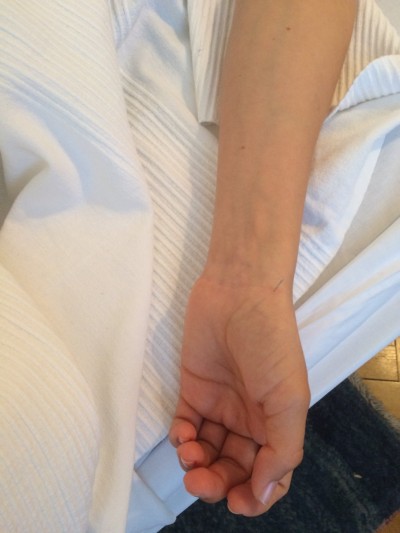Akupunktur Arm